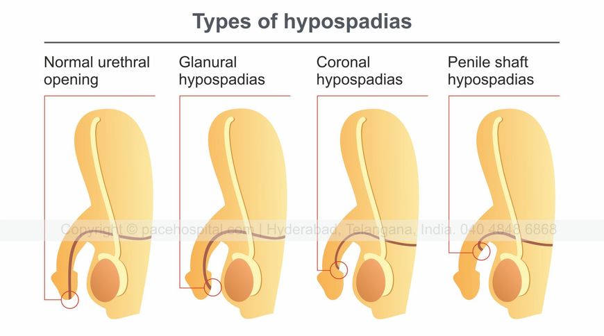 Hypospadias a rare congenital condition Diagnosis and Treatment